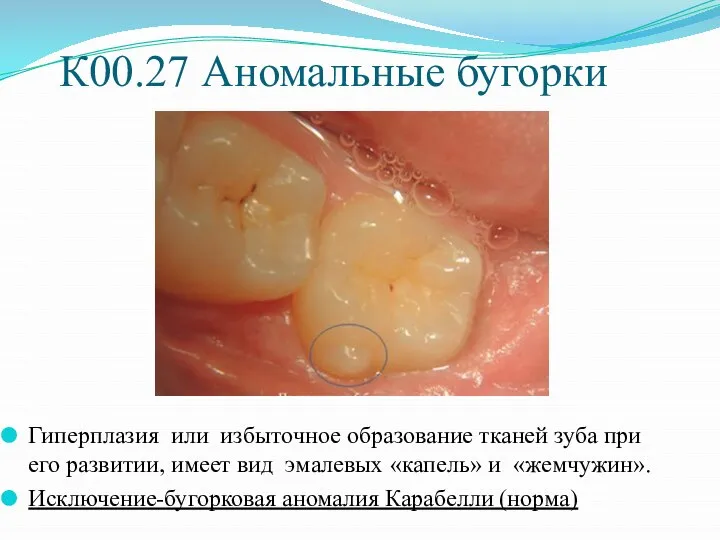 К00.27 Аномальные бугорки Гиперплазия или избыточное образование тканей зуба при его разви­тии,