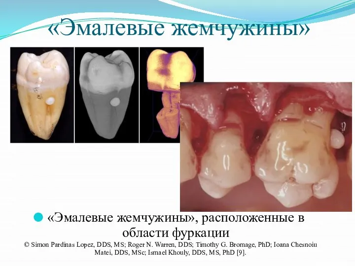 «Эмалевые жемчужины» «Эмалевые жемчужины», расположенные в области фуркации © Simon Pardinas Lopez,