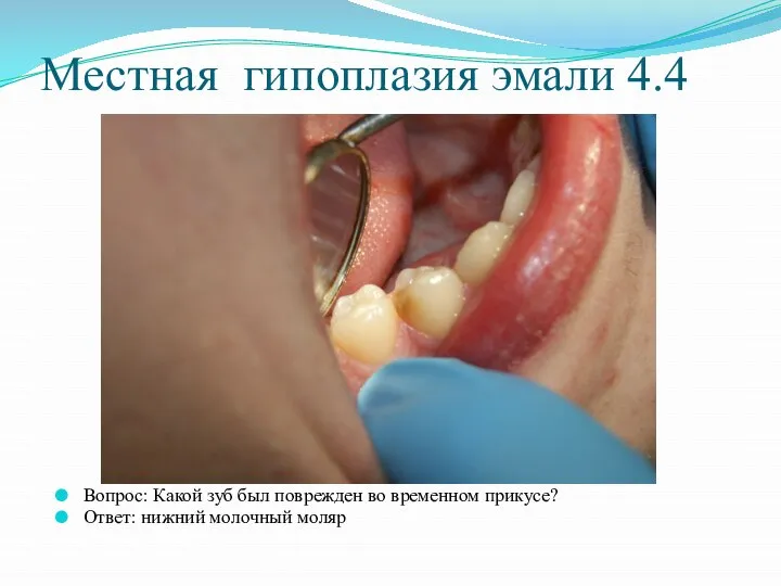 Местная гипоплазия эмали 4.4 Вопрос: Какой зуб был поврежден во временном прикусе? Ответ: нижний молочный моляр