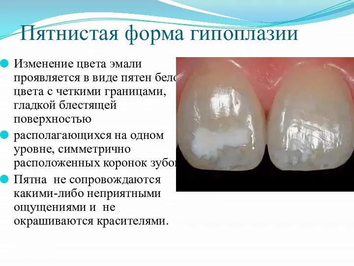 Пятнистая форма гипоплазии Изменение цвета эмали проявляется в виде пятен белого цвета