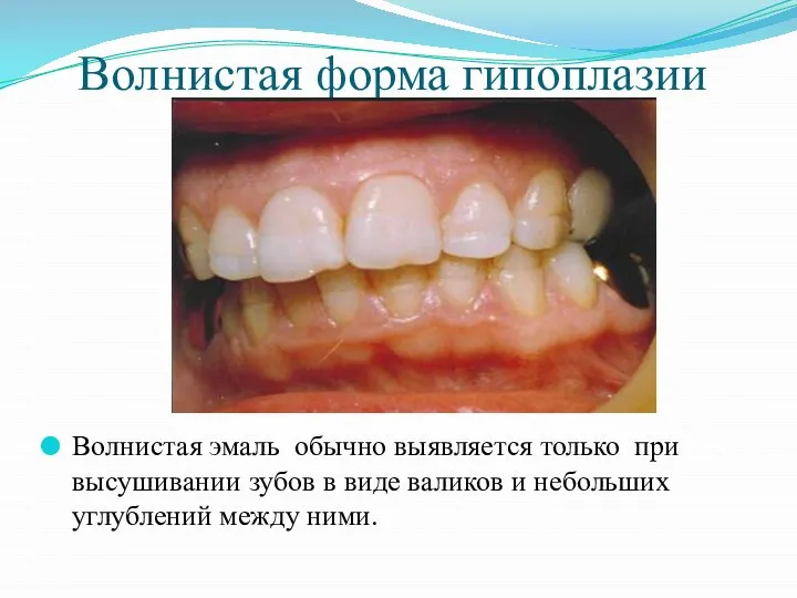 Волнистая форма гипоплазии Волнистая эмаль обычно выявляется только при высушивании зубов в