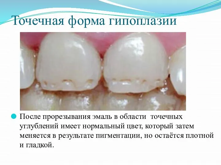 Точечная форма гипоплазии После прорезывания эмаль в области точечных углублений имеет нормальный