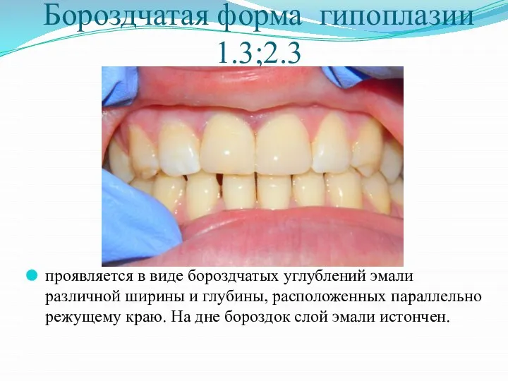 Бороздчатая форма гипоплазии 1.3;2.3 проявляется в виде бороздчатых углублений эмали различной ширины