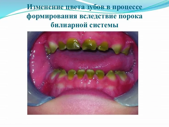 Изменение цвета зубов в процессе формирования вследствие порока билиарной системы