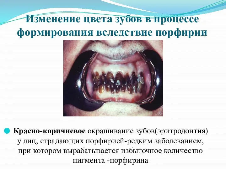 Изменение цвета зубов в процессе формирования вследствие порфирии Красно-коричневое окрашивание зубов(эритродонтия) у