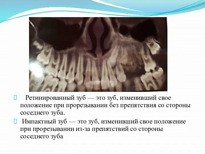 Ретинированный зуб — это зуб, изменивший свое положение при прорезывании без препятствия