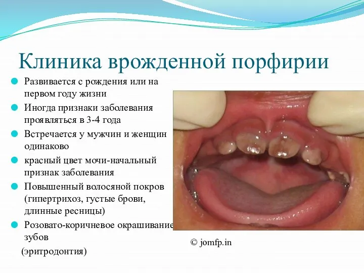 Клиника врожденной порфирии Развивается с рождения или на первом году жизни Иногда