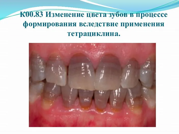 К00.83 Изменение цвета зубов в процессе формирования вследствие применения тетрациклина.