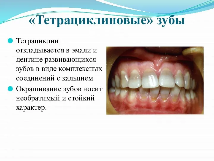 «Тетрациклиновые» зубы Тетрациклин откладывается в эмали и дентине развивающихся зубов в виде