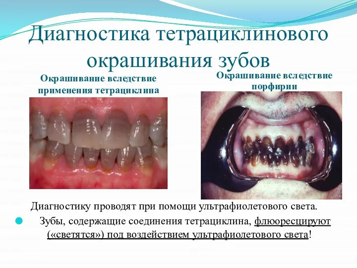 Диагностика тетрациклинового окрашивания зубов Окрашивание вследствие применения тетрациклина Окрашивание вследствие порфирии Диагностику