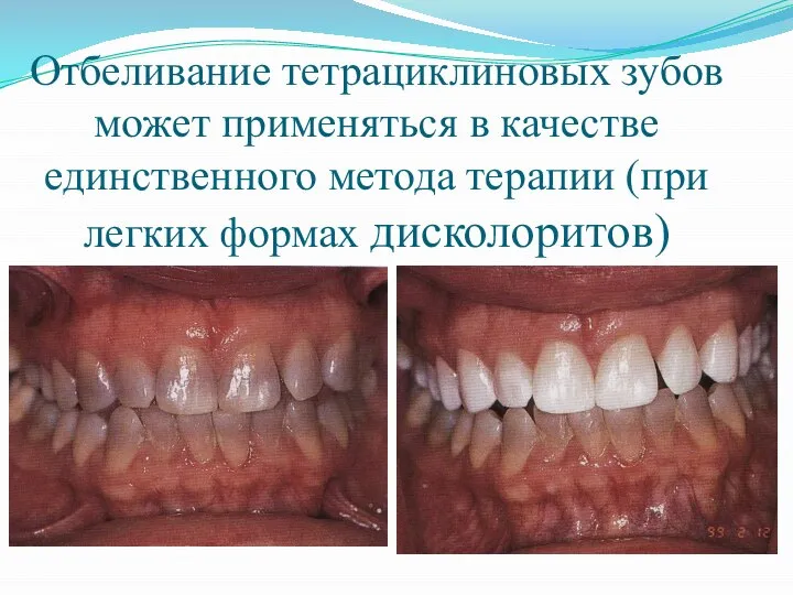 Отбеливание тетрациклиновых зубов может применяться в качестве единственного метода терапии (при легких формах дисколоритов)