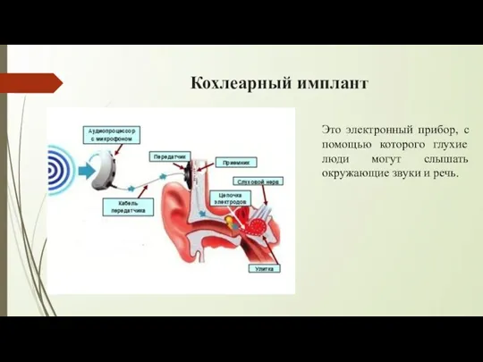 Кохлеарный имплант Это электронный прибор, с помощью которого глухие люди могут слышать окружающие звуки и речь.