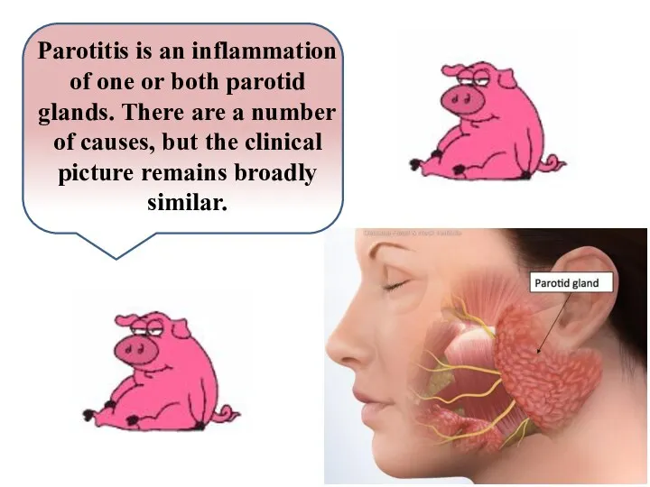 Parotitis is an inflammation of one or both parotid glands. There are