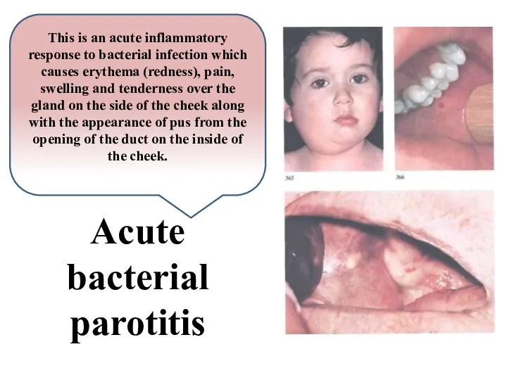 Acute bacterial parotitis This is an acute inflammatory response to bacterial infection