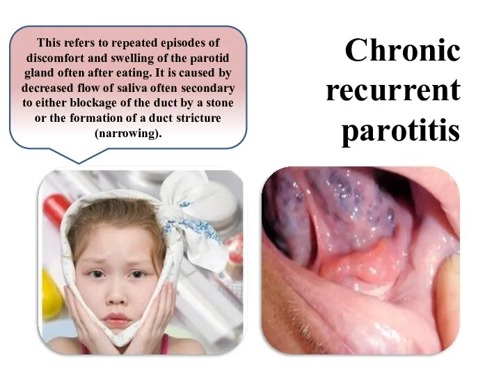 Chronic recurrent parotitis This refers to repeated episodes of discomfort and swelling