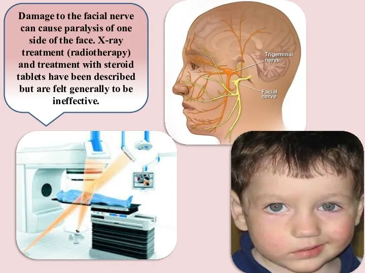 Damage to the facial nerve can cause paralysis of one side of