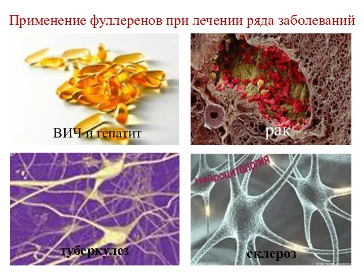 Применение фуллеренов при лечении ряда заболеваний ВИЧ и гепатит рак склероз туберкулез