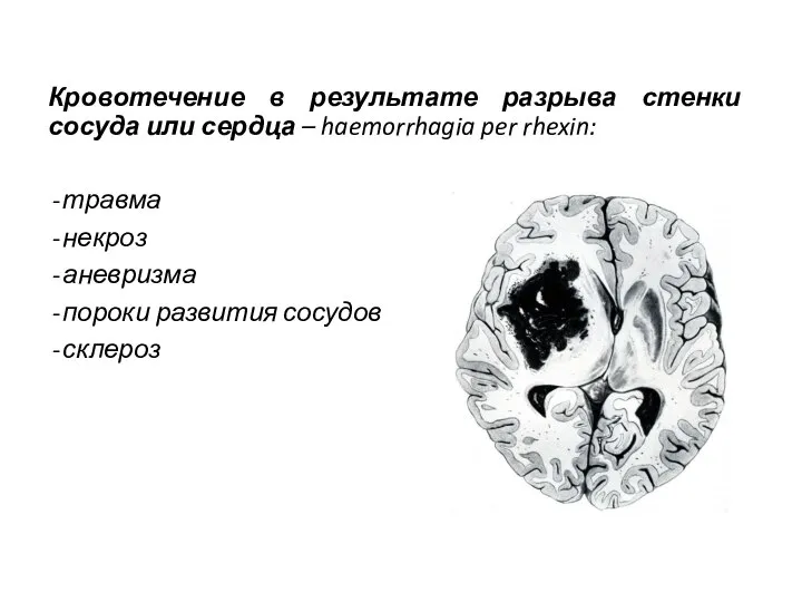 Кровотечение в результате разрыва стенки сосуда или сердца – haemorrhagia per rhexin: