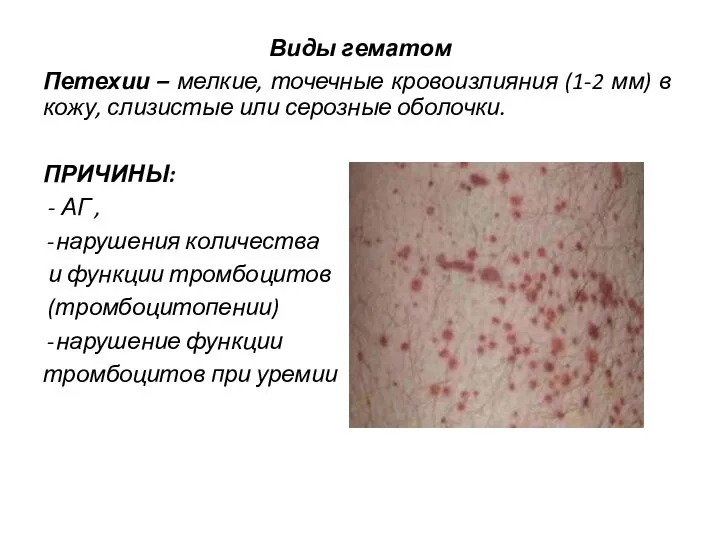 Виды гематом Петехии – мелкие, точечные кровоизлияния (1-2 мм) в кожу, слизистые