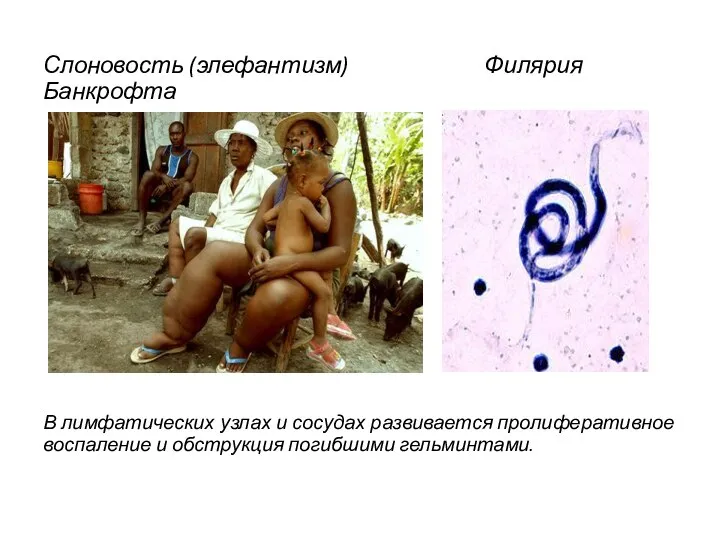 Слоновость (элефантизм) Филярия Банкрофта В лимфатических узлах и сосудах развивается пролиферативное воспаление и обструкция погибшими гельминтами.