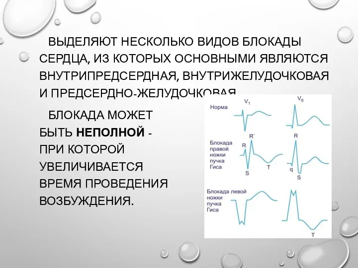 ВЫДЕЛЯЮТ НЕСКОЛЬКО ВИДОВ БЛОКАДЫ СЕРДЦА, ИЗ КОТОРЫХ ОСНОВНЫМИ ЯВЛЯЮТСЯ ВНУТРИПРЕДСЕРДНАЯ, ВНУТРИЖЕЛУДОЧКОВАЯ И