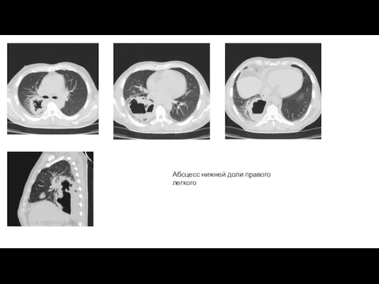Абсцесс нижней доли правого легкого