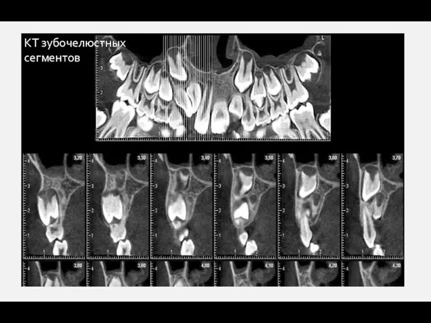 КТ зубочелюстных сегментов