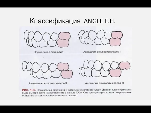 Классификация ANGLE E.H.