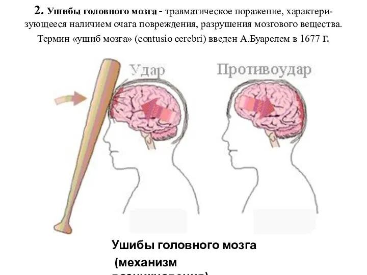 2. Ушибы головного мозга - травматическое поражение, характери- зующееся наличием очага повреждения,