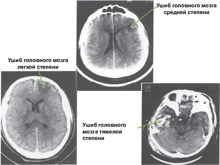 Ушиб головного мозга средней степени Ушиб головного мозга тяжелой степени Ушиб головного мозга легкой степени