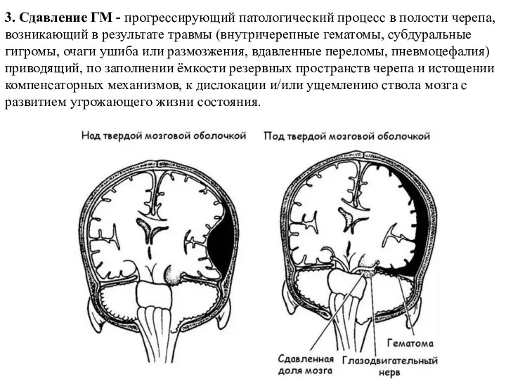 3. Сдавление ГМ - прогрессирующий патологический процесс в полости черепа, возникающий в