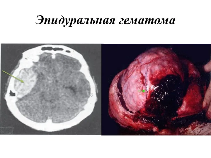 Эпидуральная гематома