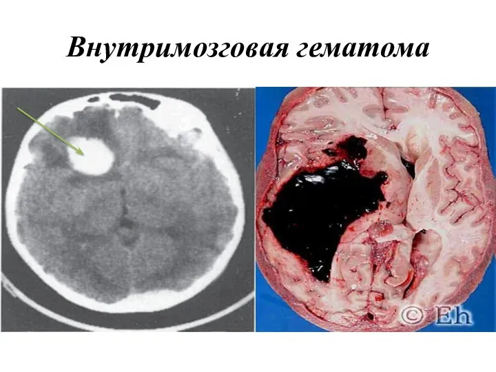 Внутримозговая гематома