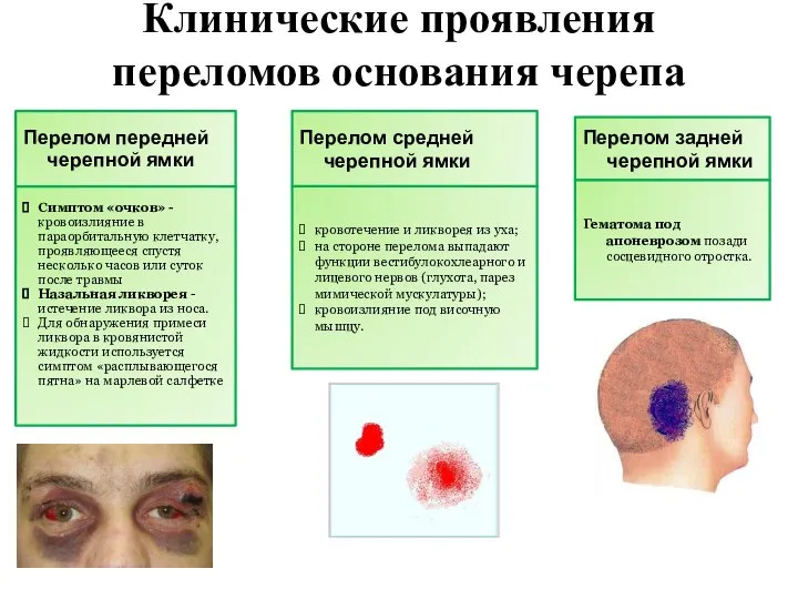 Клинические проявления переломов основания черепа Перелом передней черепной ямки Симптом «очков» -