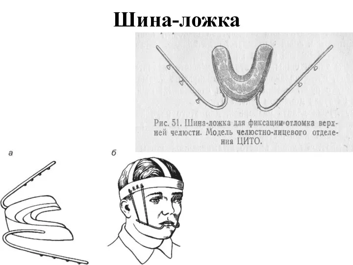 Шина-ложка