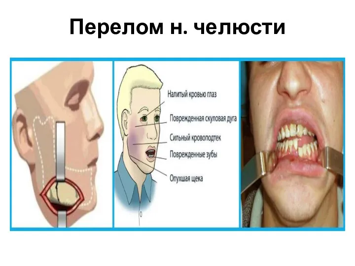 Перелом н. челюсти