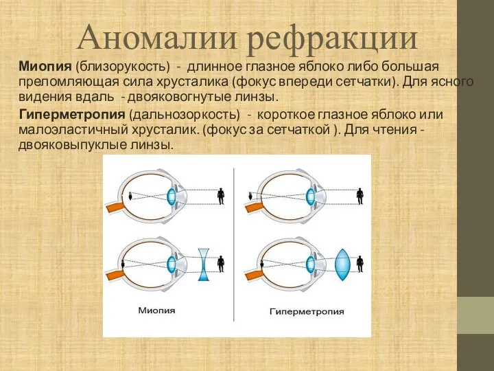 Аномалии рефракции Миопия (близорукость) - длинное глазное яблоко либо большая преломляющая сила