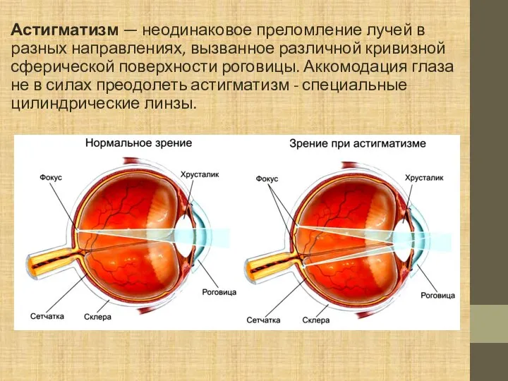 Астигматизм — неодинаковое преломление лучей в разных направлениях, вызванное различной кривизной сферической