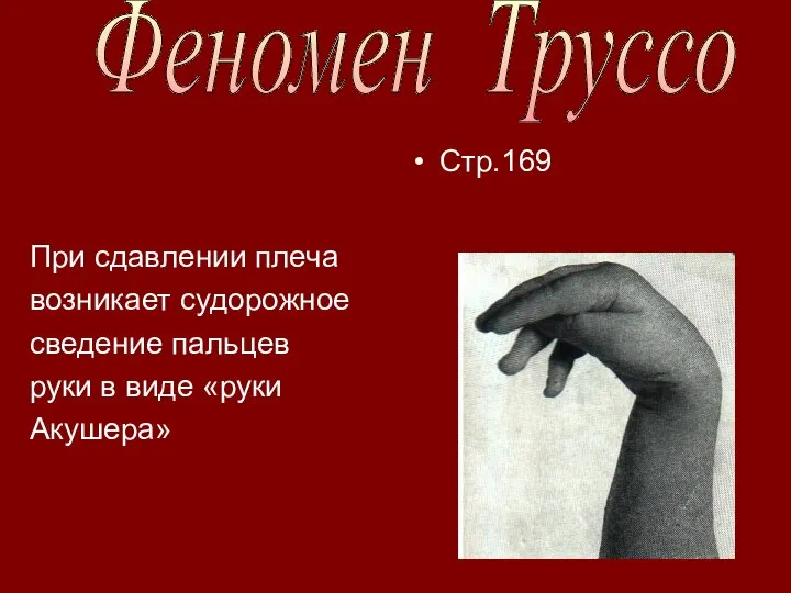 При сдавлении плеча возникает судорожное сведение пальцев руки в виде «руки Акушера» Стр.169 Феномен Труссо