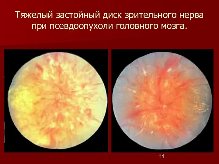 Тяжелый застойный диск зрительного нерва при псевдоопухоли головного мозга.