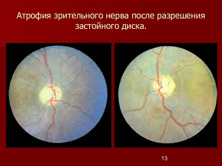 Атрофия зрительного нерва после разрешения застойного диска.