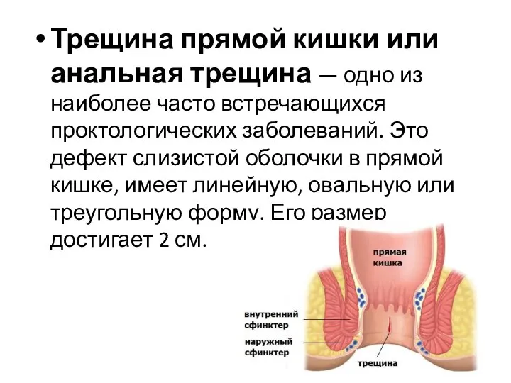 Трещина прямой кишки или анальная трещина — одно из наиболее часто встречающихся