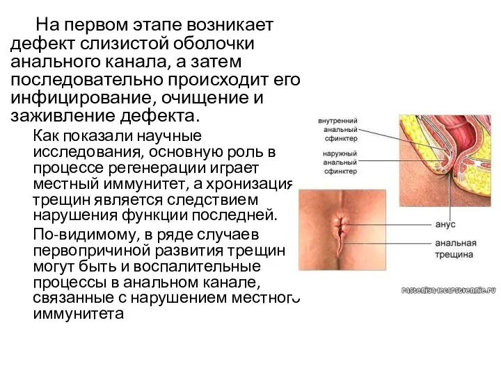 На первом этапе возникает дефект слизистой оболочки анального канала, а затем последовательно