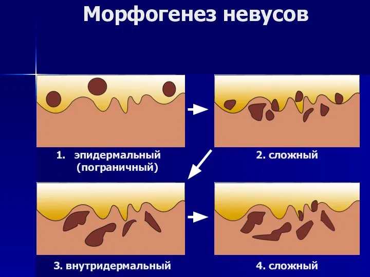 Морфогенез невусов эпидермальный (пограничный) 2. сложный 3. внутридермальный 4. сложный
