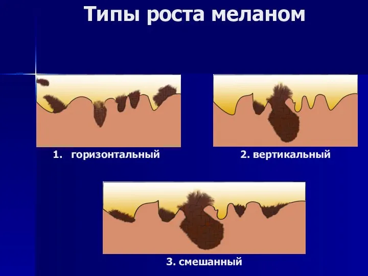 Типы роста меланом горизонтальный 2. вертикальный 3. смешанный