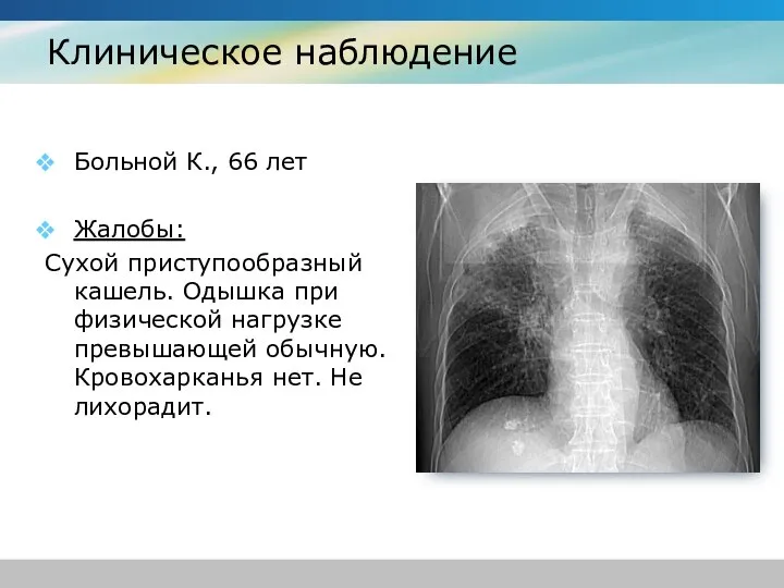 Клиническое наблюдение Больной К., 66 лет Жалобы: Сухой приступообразный кашель. Одышка при