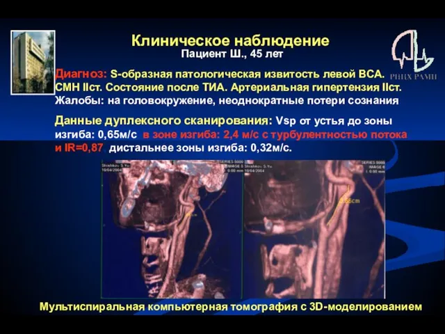 Клиническое наблюдение Пациент Ш., 45 лет Диагноз: S-образная патологическая извитость левой ВСА.