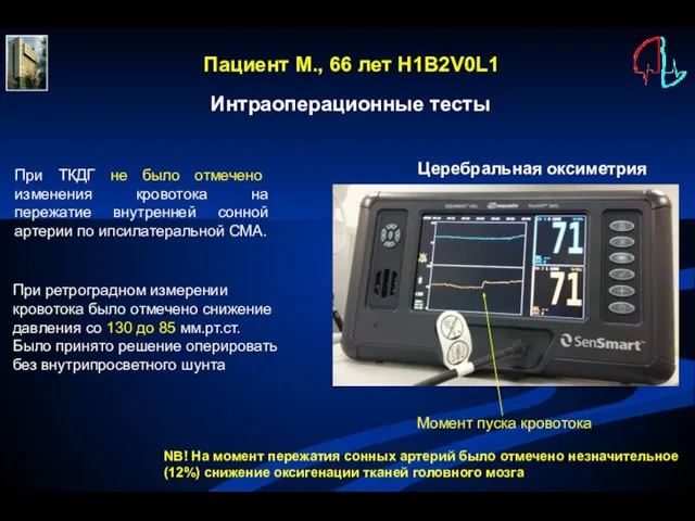 Пациент М., 66 лет H1B2V0L1 Интраоперационные тесты Момент пуска кровотока При ТКДГ