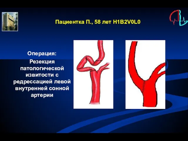 Операция: Резекция патологической извитости с редрессацией левой внутренней сонной артерии Пациентка П., 58 лет H1B2V0L0