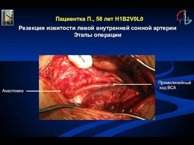 Резекция извитости левой внутренней сонной артерии Этапы операции Пациентка П., 58 лет